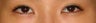 Bilateral Asian Eyelid Surgery