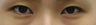 Bilateral Asian Eyelid Surgery