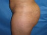 Butt Augmentation