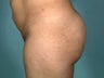 Butt Augmentation