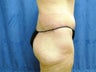 Body Lift