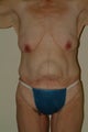 Hernia