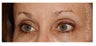 Eye Area Rejuvenation
