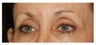 Eye Area Rejuvenation