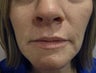 Dermabrasion in 46 year old woman