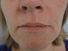 Dermabrasion in 46 year old woman