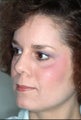 Reconstructive Rhinoplasty