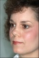Reconstructive Rhinoplasty