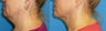 46 Y.O. Female underwent liposuction of the neck