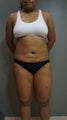 28 yr. old with generalised fat deposition (VASER)