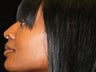 Atlanta Nose Job Surgery