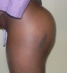 42 year old woman has Butt Augmentation