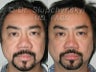 50 Year Old Asian Male - Revision Rhinoplasty