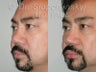 50 Year Old Asian Male - Revision Rhinoplasty