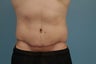 Abdominoplasty
