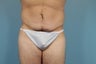 Abdominoplasty
