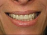BriteSmile in-office bleaching and 6 porcelain crowns.