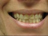 BriteSmile in-office bleaching and 6 porcelain crowns.