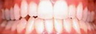 Crowding Treated with Invisalign
