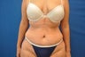 Tummy Tuck