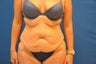 Tummy Tuck