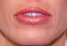 Before and After Upper & Lower Lip Lift