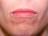 Before and After Upper & Lower Lip Lift