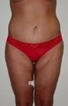 45 year old female patient