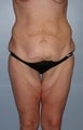 45 year old female patient