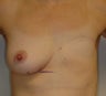 Breast Reconstruction