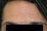 Dysport (Botox) for Men Before and After