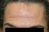 Dysport (Botox) for Men Before and After