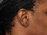 44 Year Old Female With Torn Earlobes
