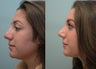 Nose Surgery / Rhinoplasty