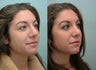 Nose Surgery / Rhinoplasty
