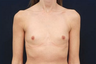 Breast Augmentation