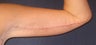Arm Lift