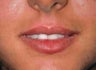 Lip Augmentation