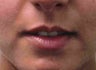 Lip Augmentation