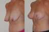 Breast Lift