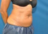 CoolSculpting