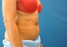 CoolSculpting
