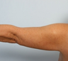 Arm Lift