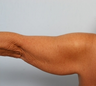 Arm Lift