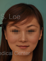 Asian Nose Surgery