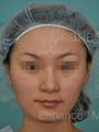 Asian Nose Surgery