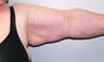 Female patient who underwent an arm lift