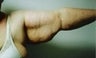 Female patient who underwent an arm lift