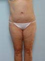 Body Lift