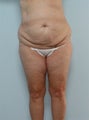 Body Lift